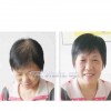 蘭州提供專業的隱形補發|蘭州哪家補發比較好